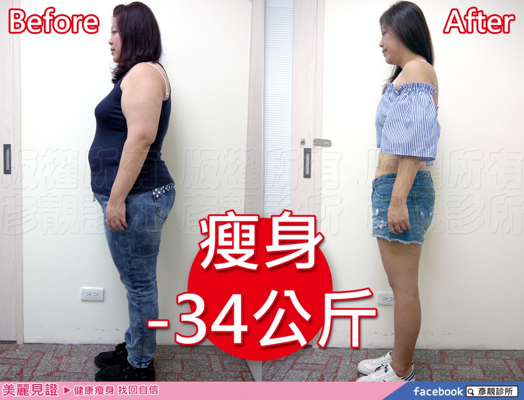 【減重瘦身】成功瘦身-34公斤酪梨型肥胖身材推薦-彥靚診所減