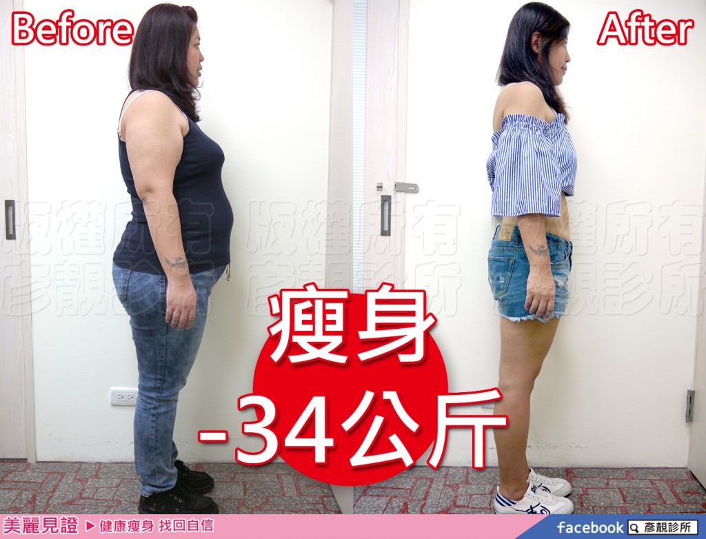 【減重瘦身】成功瘦身-34公斤酪梨型肥胖身材推薦-彥靚診所減